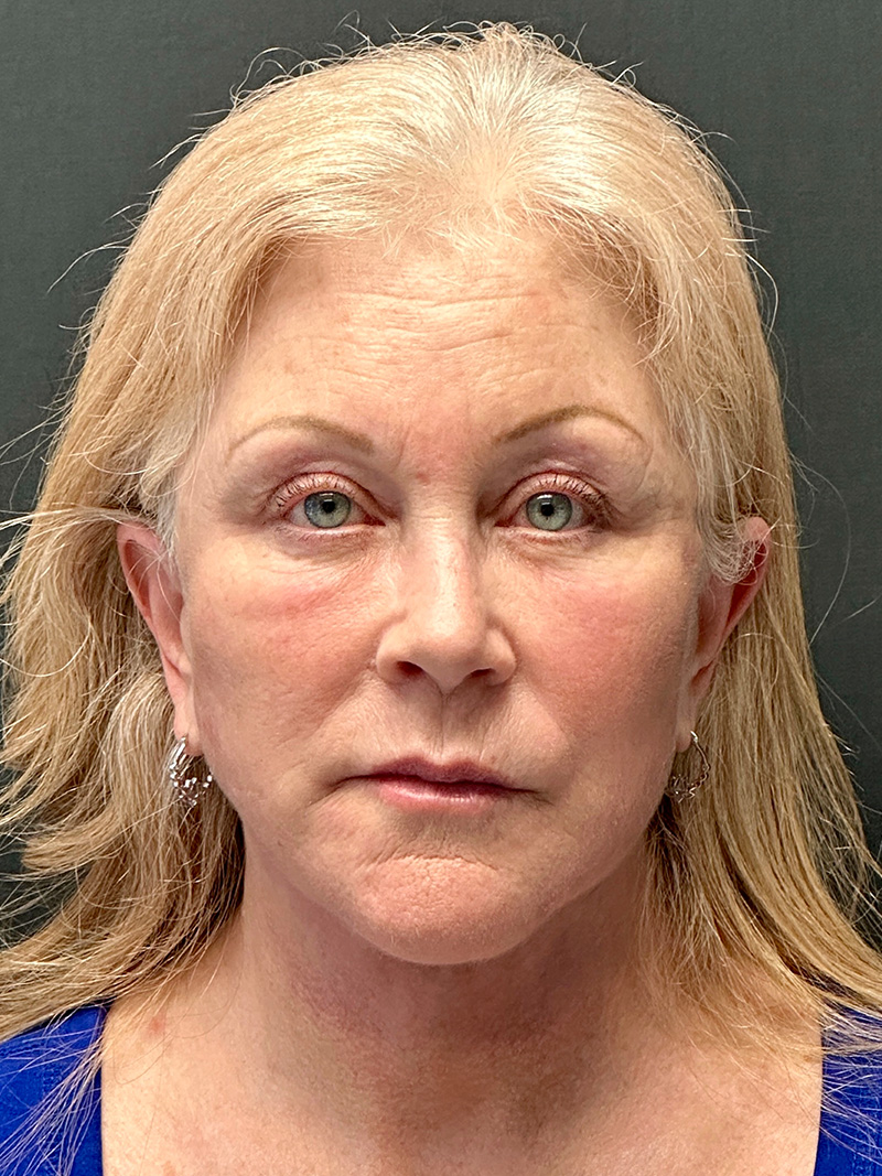 Brow Lift Miami Brow Lift in Coral Gables Dr. Paul Afrooz