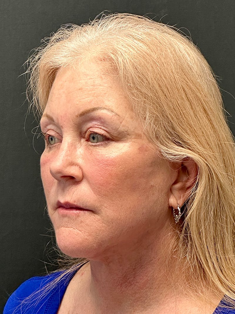 Facial Fat Grafting Before & After Gallery - Patient 391012 - Image 4
