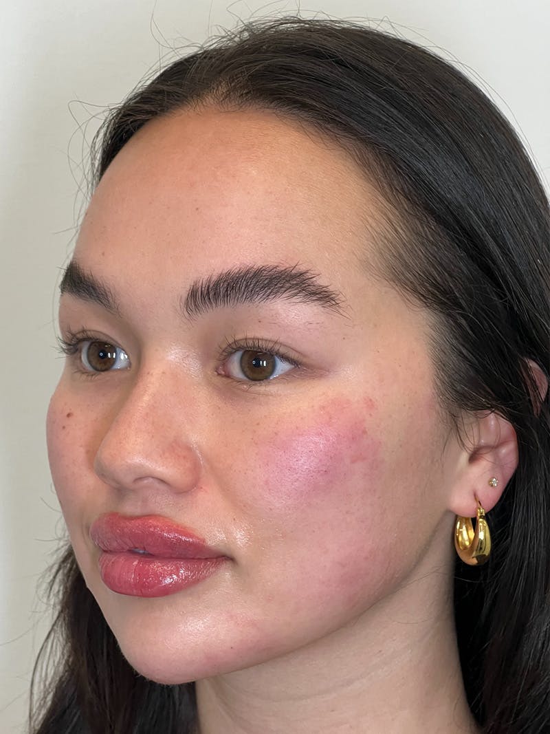 Facial Balancing Before & After Gallery - Patient 754460 - Image 3