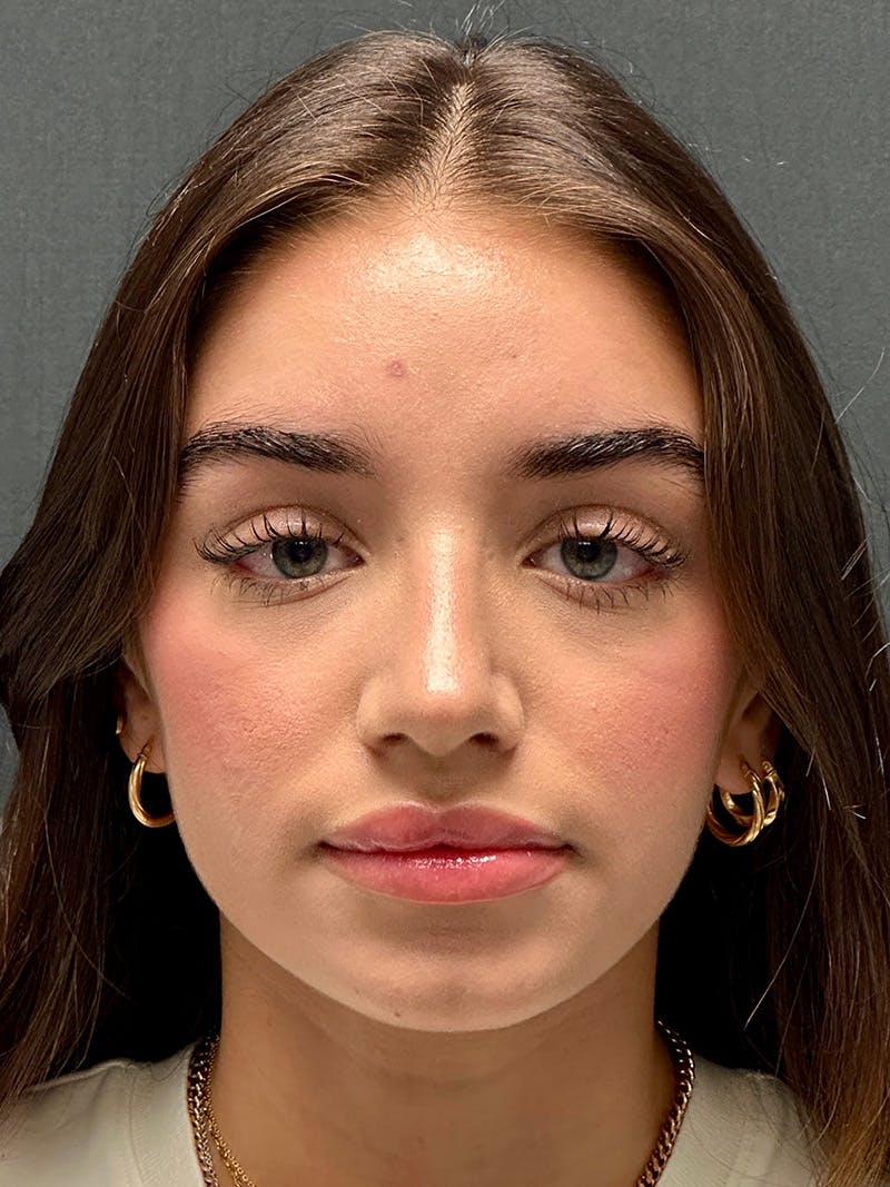 Primary Rhinoplasty Before & After Gallery - Patient 136099 - Image 2