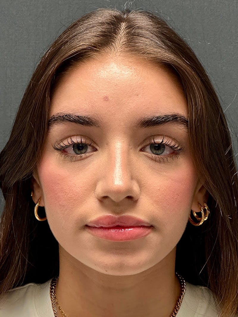 Primary Rhinoplasty Before & After Gallery - Patient 136099 - Image 2