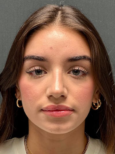 Primary Rhinoplasty Before & After Gallery - Patient 136099 - Image 2
