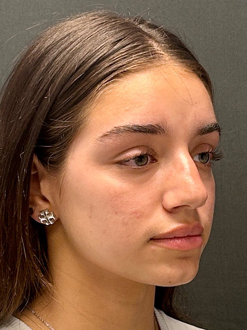 Primary Rhinoplasty Before & After Gallery - Patient 136099 - Image 3