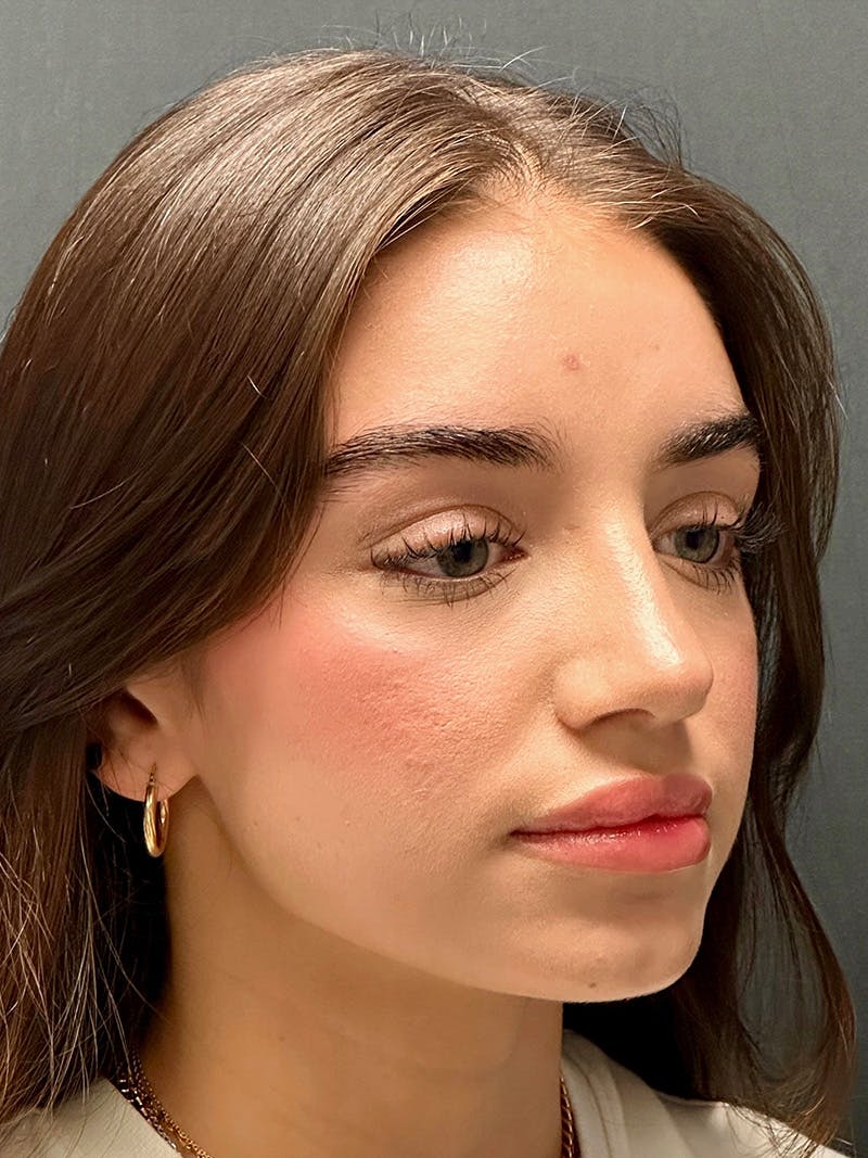 Primary Rhinoplasty Before & After Gallery - Patient 136099 - Image 4