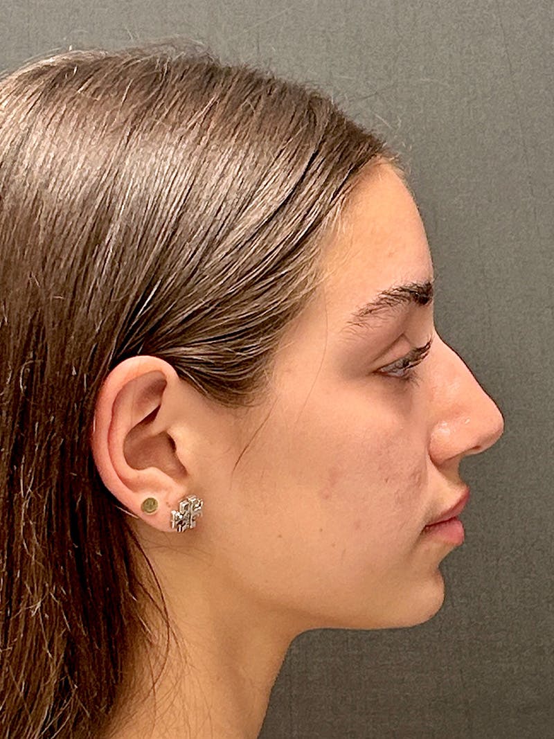 Primary Rhinoplasty Before & After Gallery - Patient 136099 - Image 5