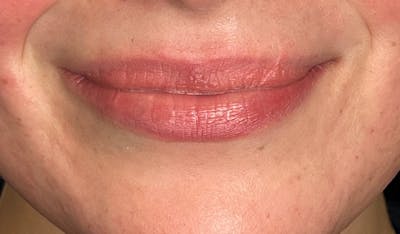 Lip Filler Before & After Gallery - Patient 233715 - Image 1