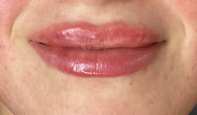 Lip Filler Before & After Gallery - Patient 233715 - Image 2