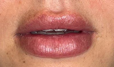 Lip Filler Before & After Gallery - Patient 273736 - Image 1