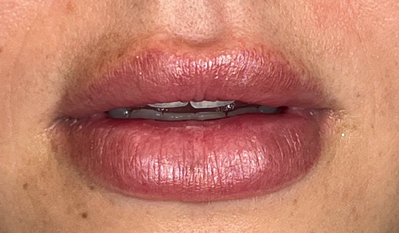 Lip Filler Before & After Gallery - Patient 273736 - Image 1