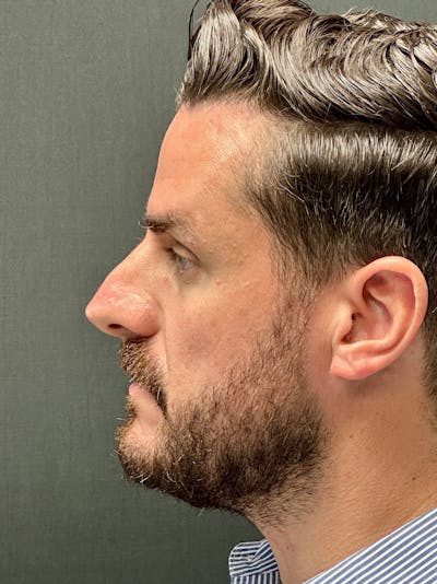 Primary Rhinoplasty Before & After Gallery - Patient 133495 - Image 1