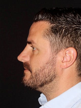 Primary Rhinoplasty Before & After Gallery - Patient 133495 - Image 2