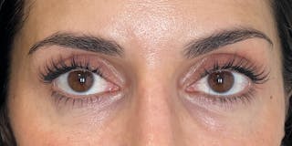 EZ Gel PRF Before & After Gallery - Patient 326492 - Image 4