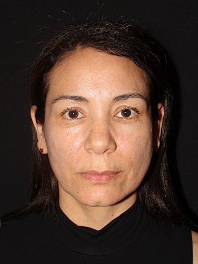 Facelift Before & After Gallery - Patient 415809 - Image 1
