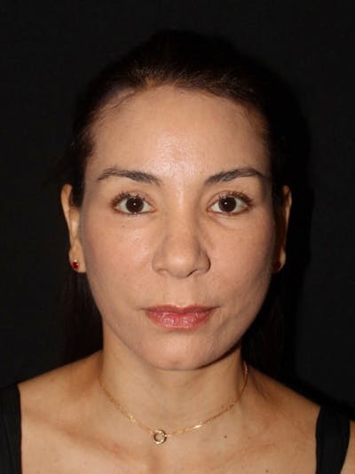 Brow Lift Before & After Gallery - Patient 624916 - Image 2