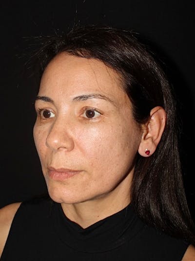 Neck Lift Before & After Gallery - Patient 240472 - Image 1