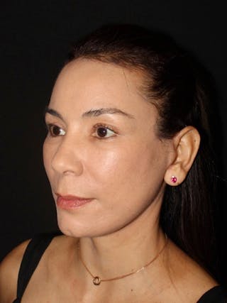 Neck Lift Before & After Gallery - Patient 240472 - Image 4