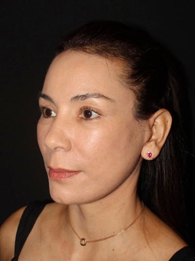 Neck Lift Before & After Gallery - Patient 240472 - Image 2