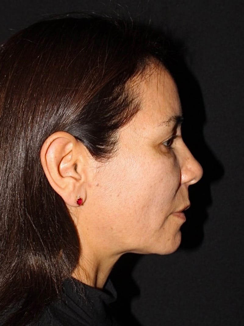 Facial Fat Grafting Before & After Gallery - Patient 391725 - Image 5