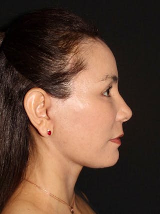 Neck Lift Before & After Gallery - Patient 240472 - Image 6