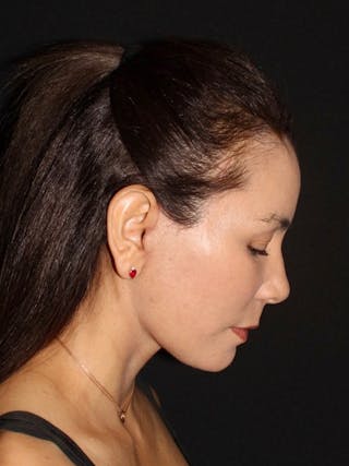 Brow Lift Before & After Gallery - Patient 134043 - Image 8