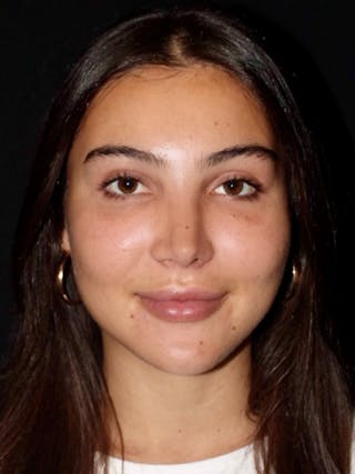 Primary Rhinoplasty Before & After Gallery - Patient 237977 - Image 4