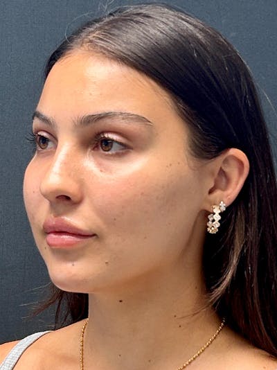 Primary Rhinoplasty Before & After Gallery - Patient 237977 - Image 1