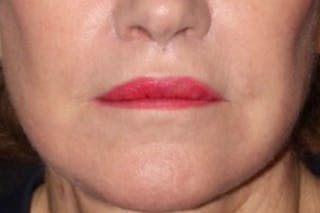 Lip Lift Before & After Gallery - Patient 382685 - Image 2