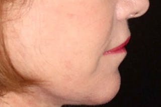Lip Lift Before & After Gallery - Patient 382685 - Image 6