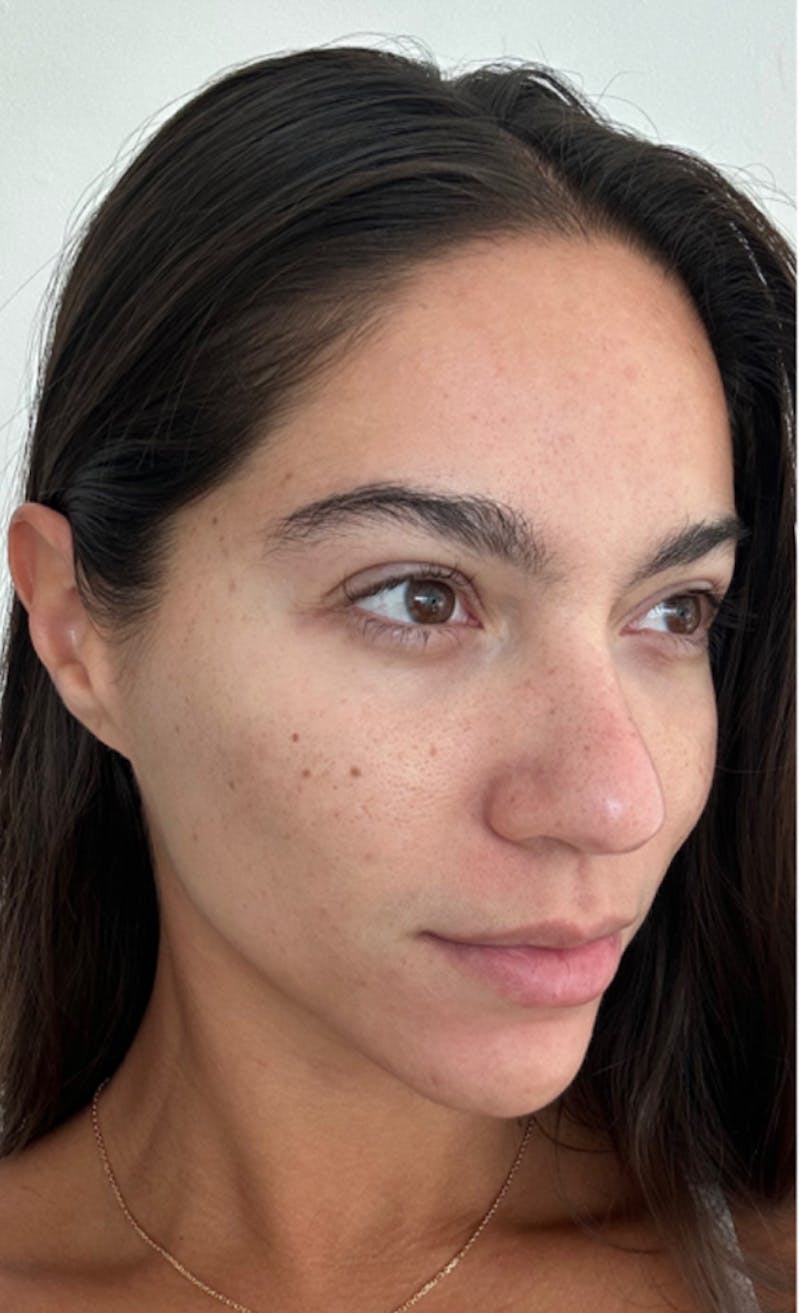 Moxi Laser Before & After Gallery - Patient 203602 - Image 2