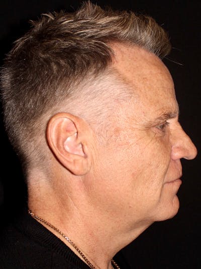 Primary Rhinoplasty Before & After Gallery - Patient 219359 - Image 1
