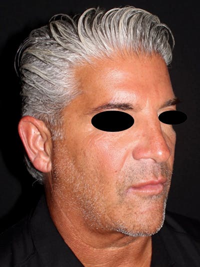 Neck Lift Before & After Gallery - Patient 364560 - Image 1