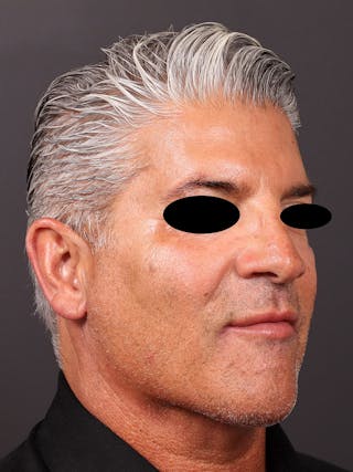 Neck Lift Before & After Gallery - Patient 364560 - Image 4