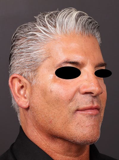 Neck Lift Before & After Gallery - Patient 364560 - Image 2