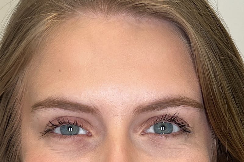 BOTOX Before & After Gallery - Patient 117097 - Image 8