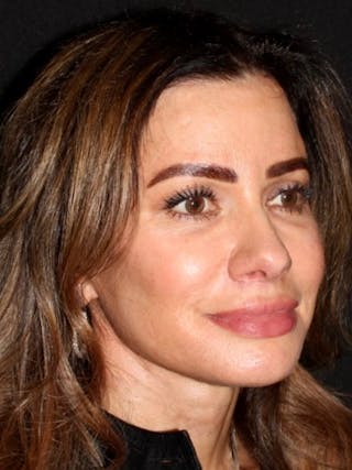 Brow Lift Before & After Gallery - Patient 352548 - Image 4