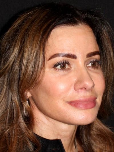 Neck Lift Before & After Gallery - Patient 254298 - Image 2