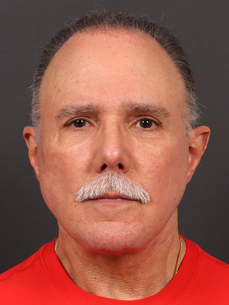 Male Face & Neck Before & After Gallery - Patient 387444 - Image 2