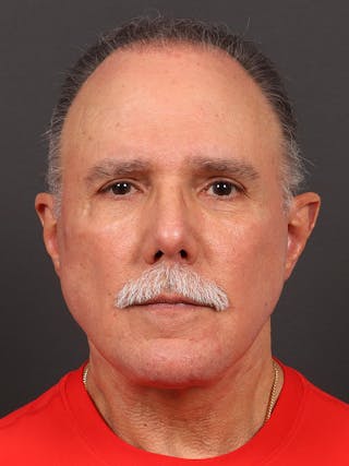Facelift Before & After Gallery - Patient 123472 - Image 2