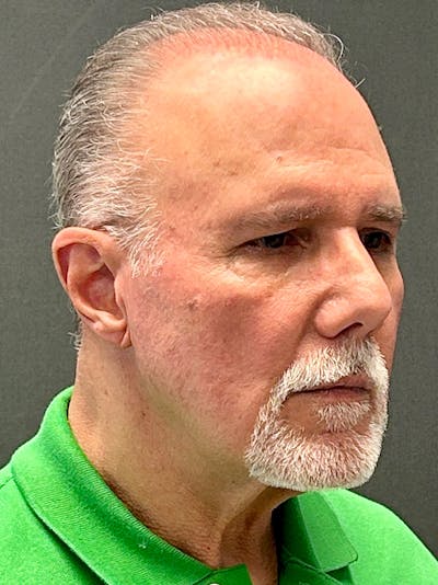 Neck Lift Before & After Gallery - Patient 653718 - Image 1