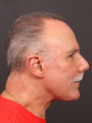 Facelift Before & After Gallery - Patient 123472 - Image 6
