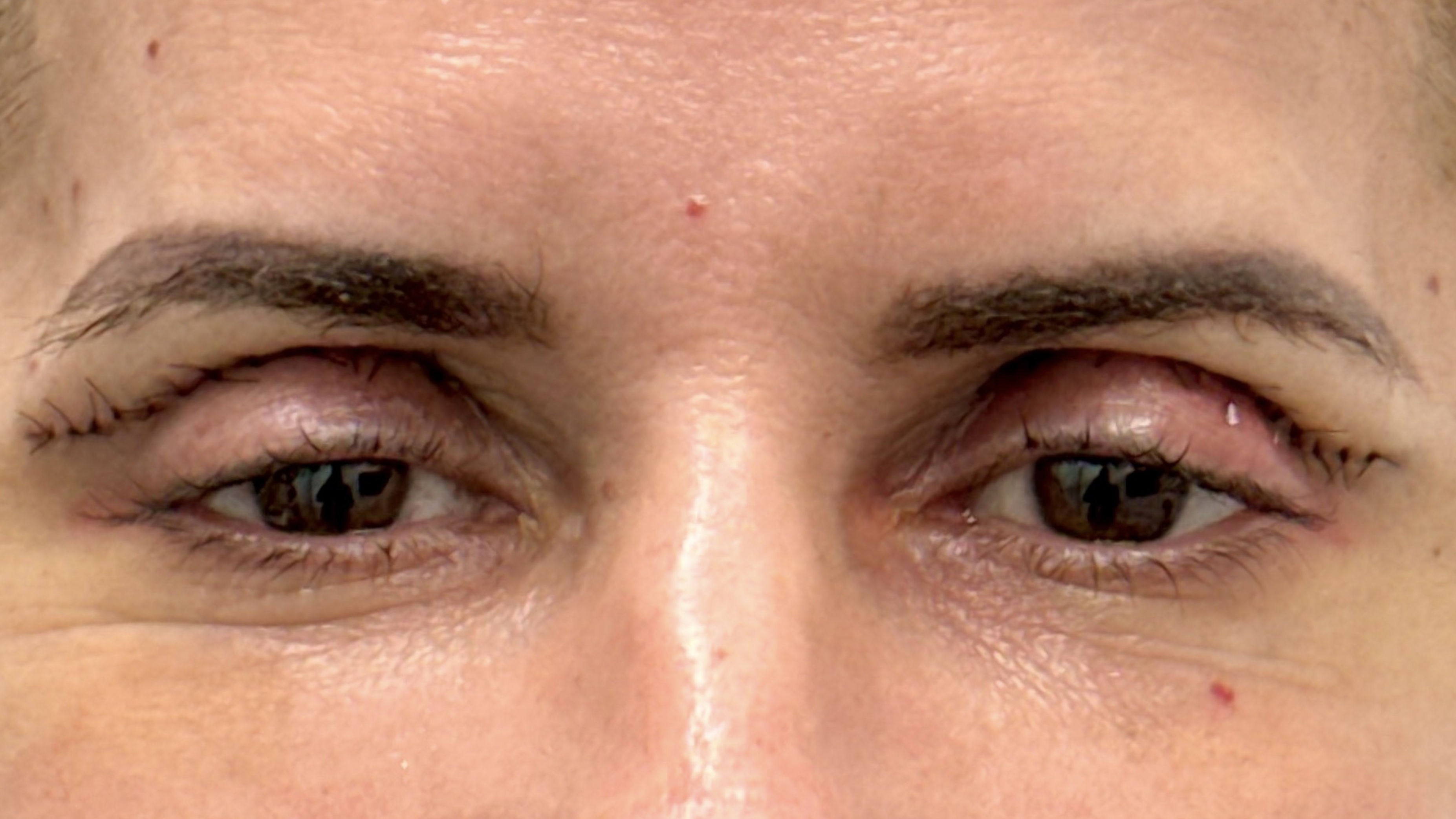 2 Days Post Upper Blepharoplasty Surgery