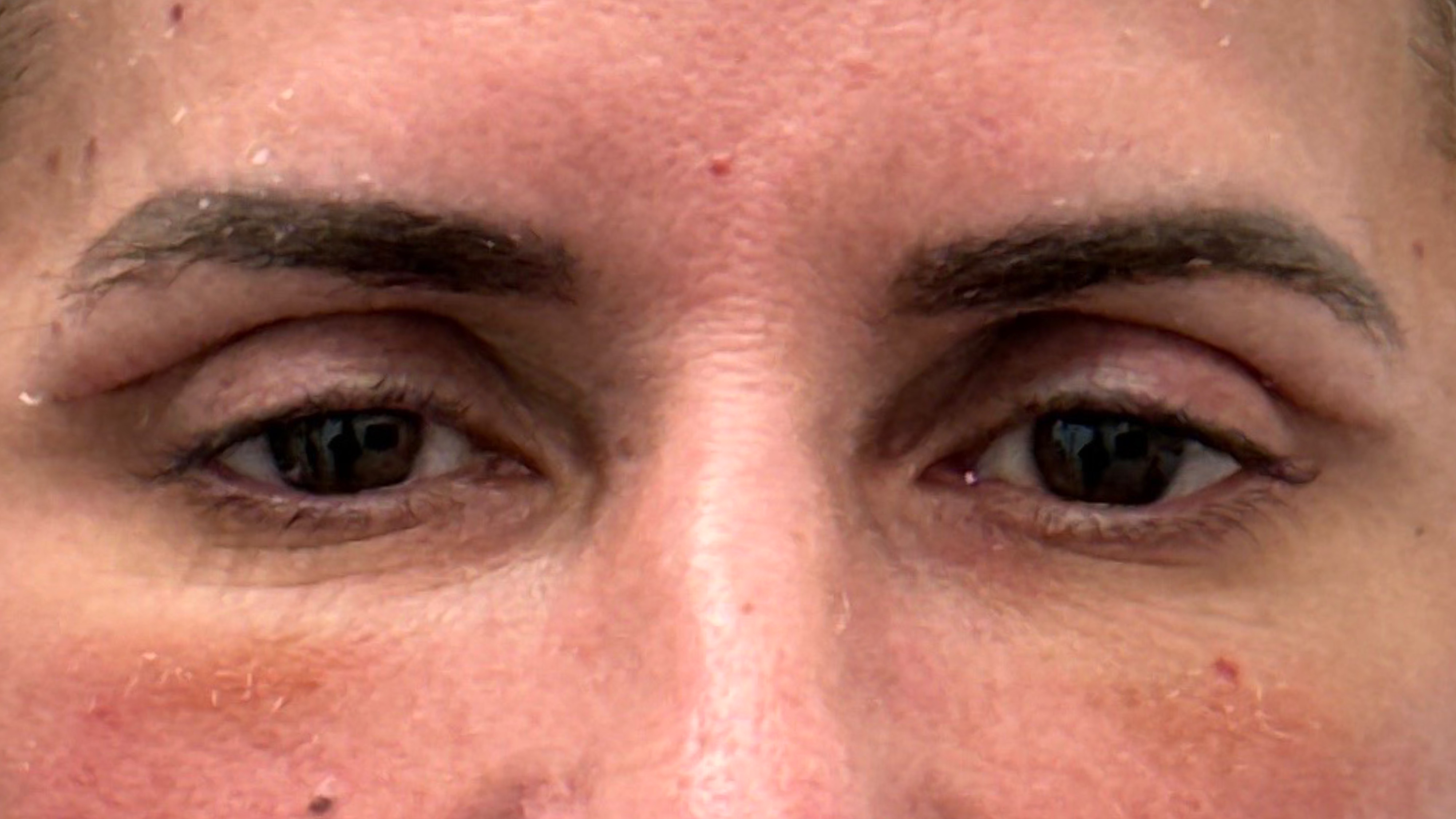 9 Days Post Upper Blepharoplasty Surgery