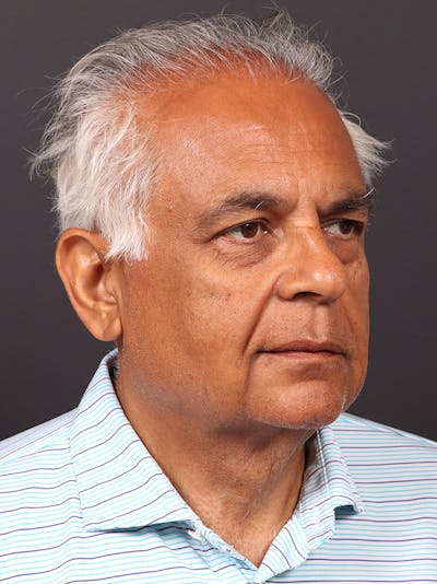 Neck Lift Before & After Gallery - Patient 323147 - Image 1