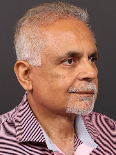 Neck Lift Before & After Gallery - Patient 323147 - Image 2