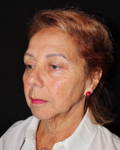 Neck Lift Before & After Gallery - Patient 193068 - Image 1