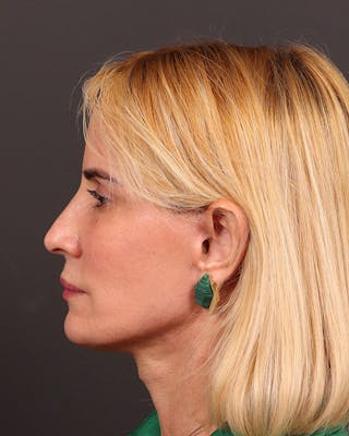 Facelift Before & After Gallery - Patient 386167 - Image 6