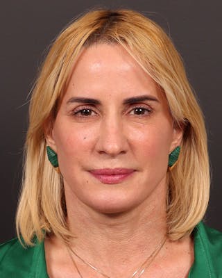 Facelift Before & After Gallery - Patient 386167 - Image 2