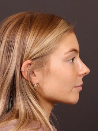 Primary Rhinoplasty Before & After Gallery - Patient 378034 - Image 2