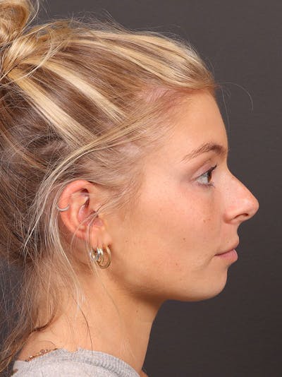 Primary Rhinoplasty Before & After Gallery - Patient 378034 - Image 1