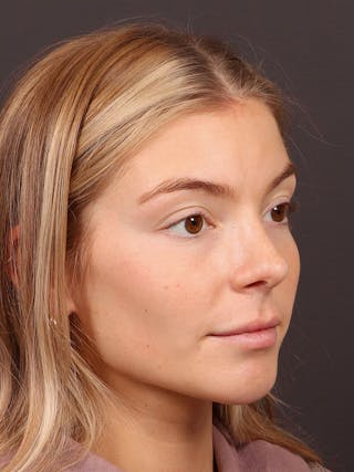 Primary Rhinoplasty Before & After Gallery - Patient 378034 - Image 6